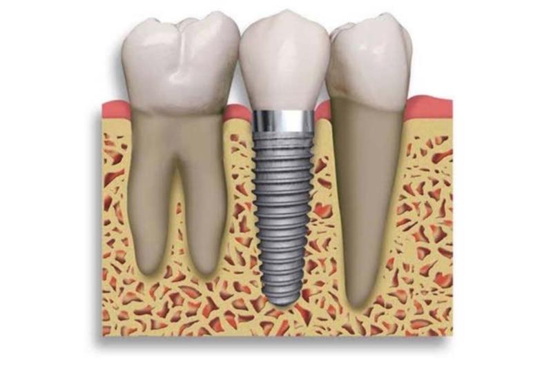 Soluções e possibilidades de  tratamento com os implantes dentários