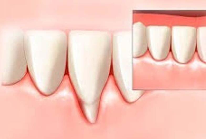 Como prevenir a recessão gengival?