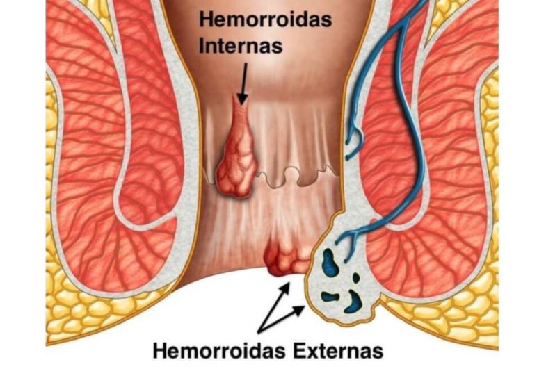 Doutor, será que esses carocinhos são hemorróidas?