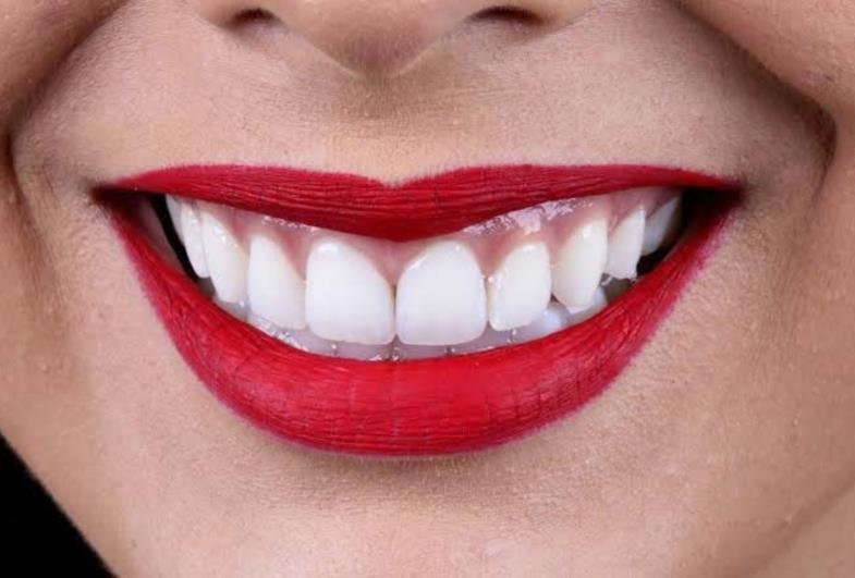 Procedimento Estético - Dúvidas sobre o clareamento dental?