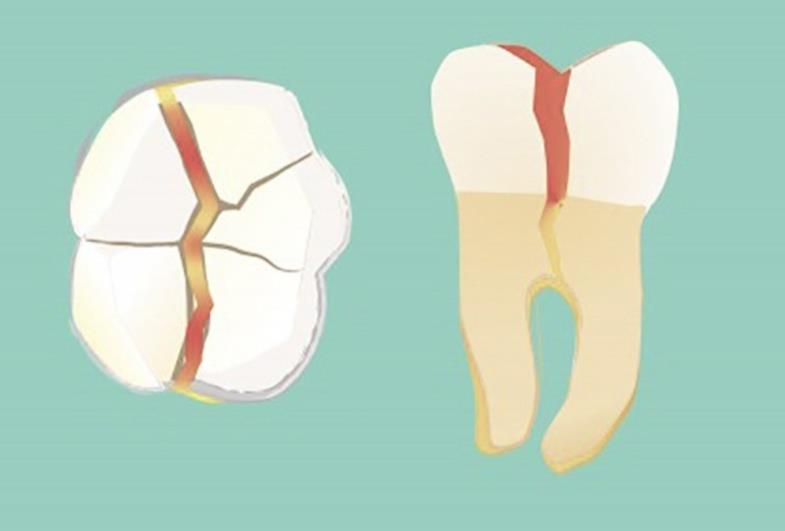 Por que formam trincas nos dentes?