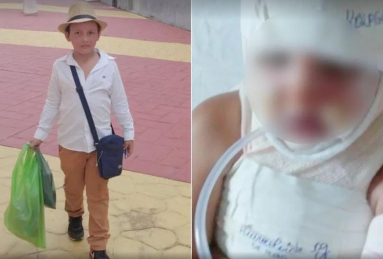Pai de menino que se queimou ao brincar com desodorante destaca importância da conscientização: 'Não sabia dos riscos'