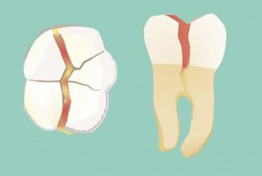 Por que formam trincas nos dentes?